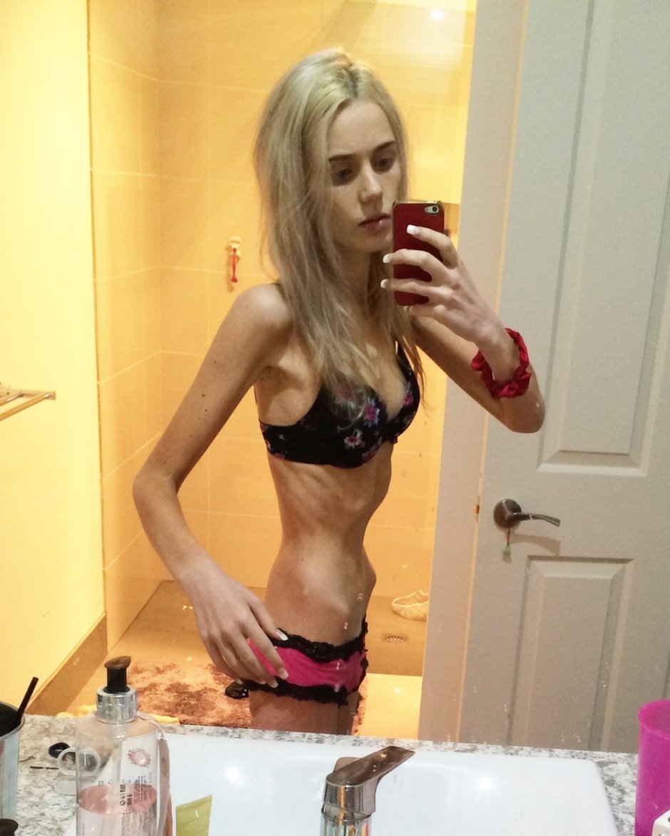 Lina Ezhevskaya anorexica