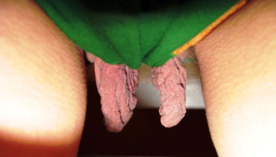 Long labia in shorts