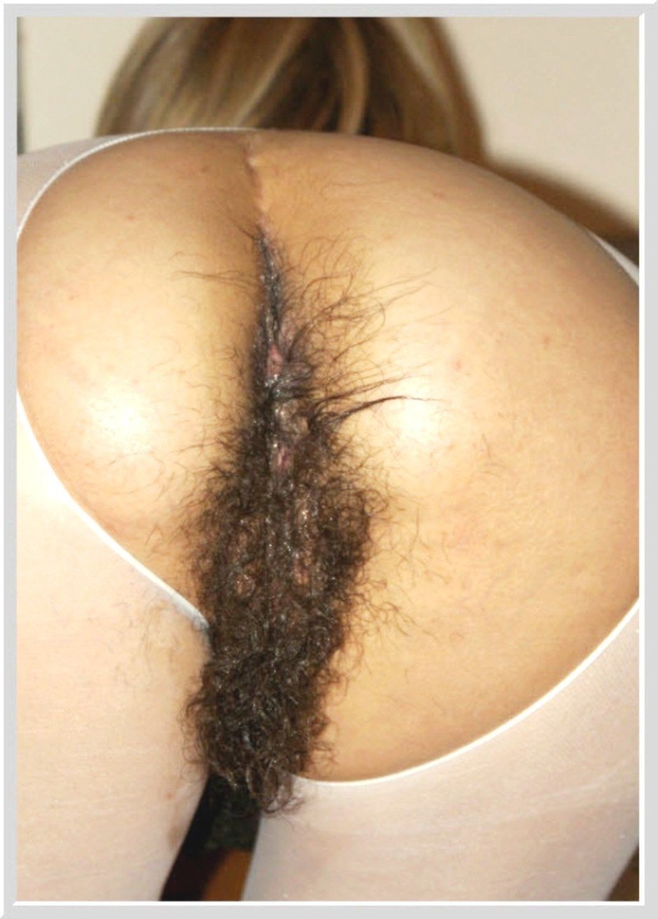 Dirty hairy anus in women