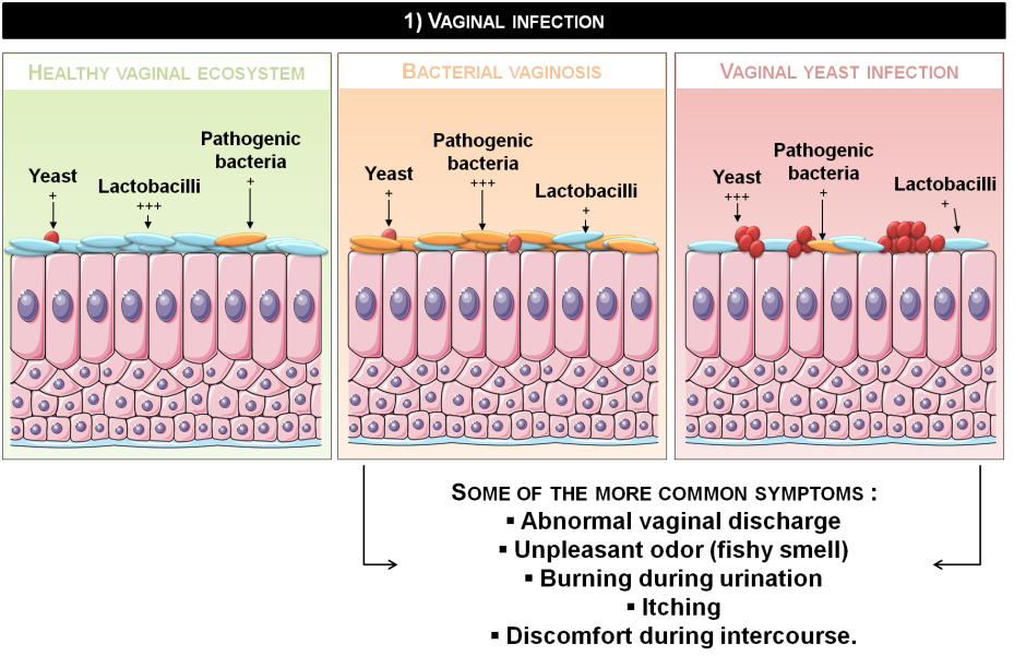 Candida Albikans in the throat