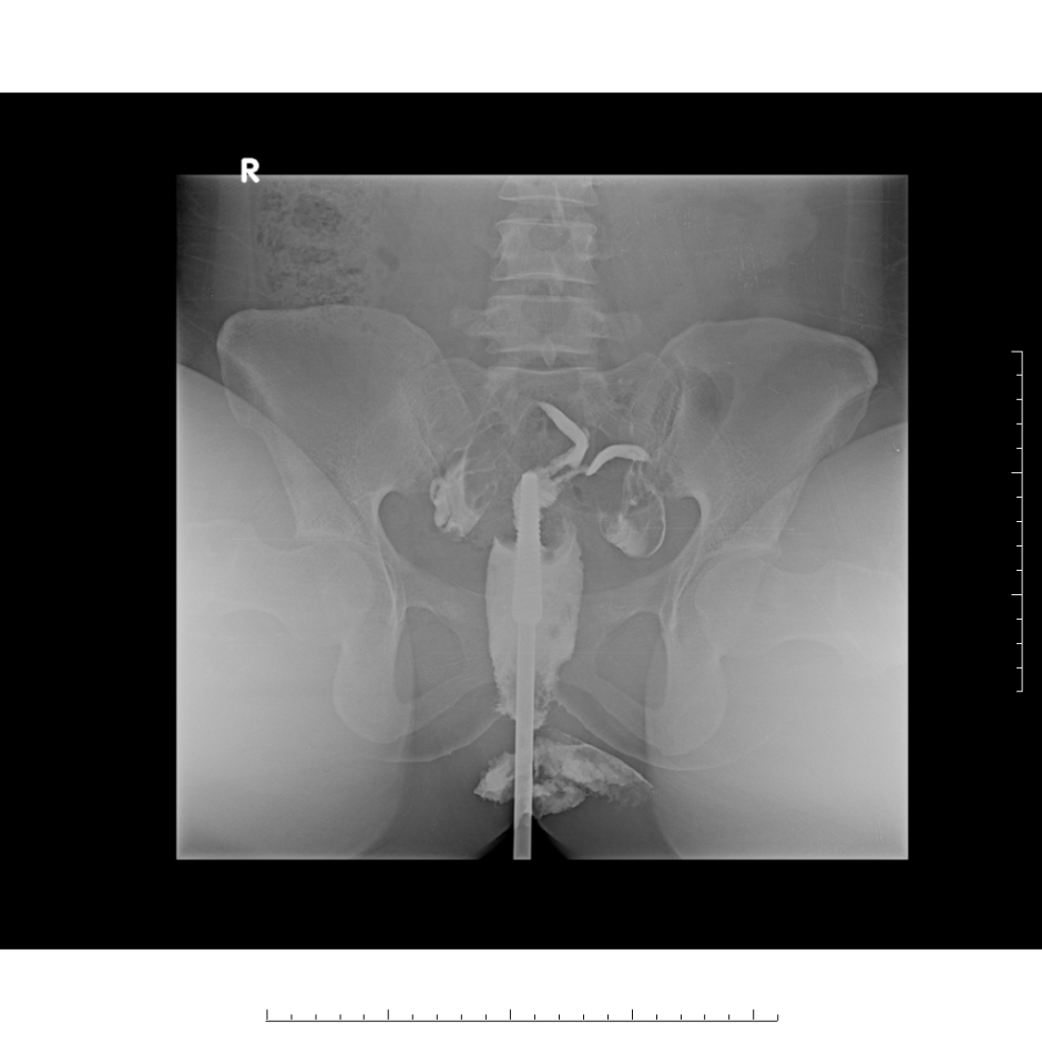 Femine X -ray uterine