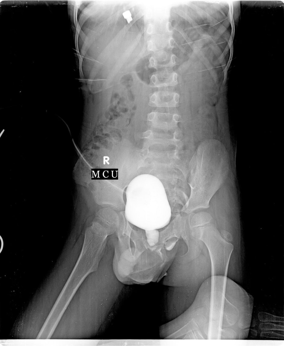 Masturbation with unusual objects