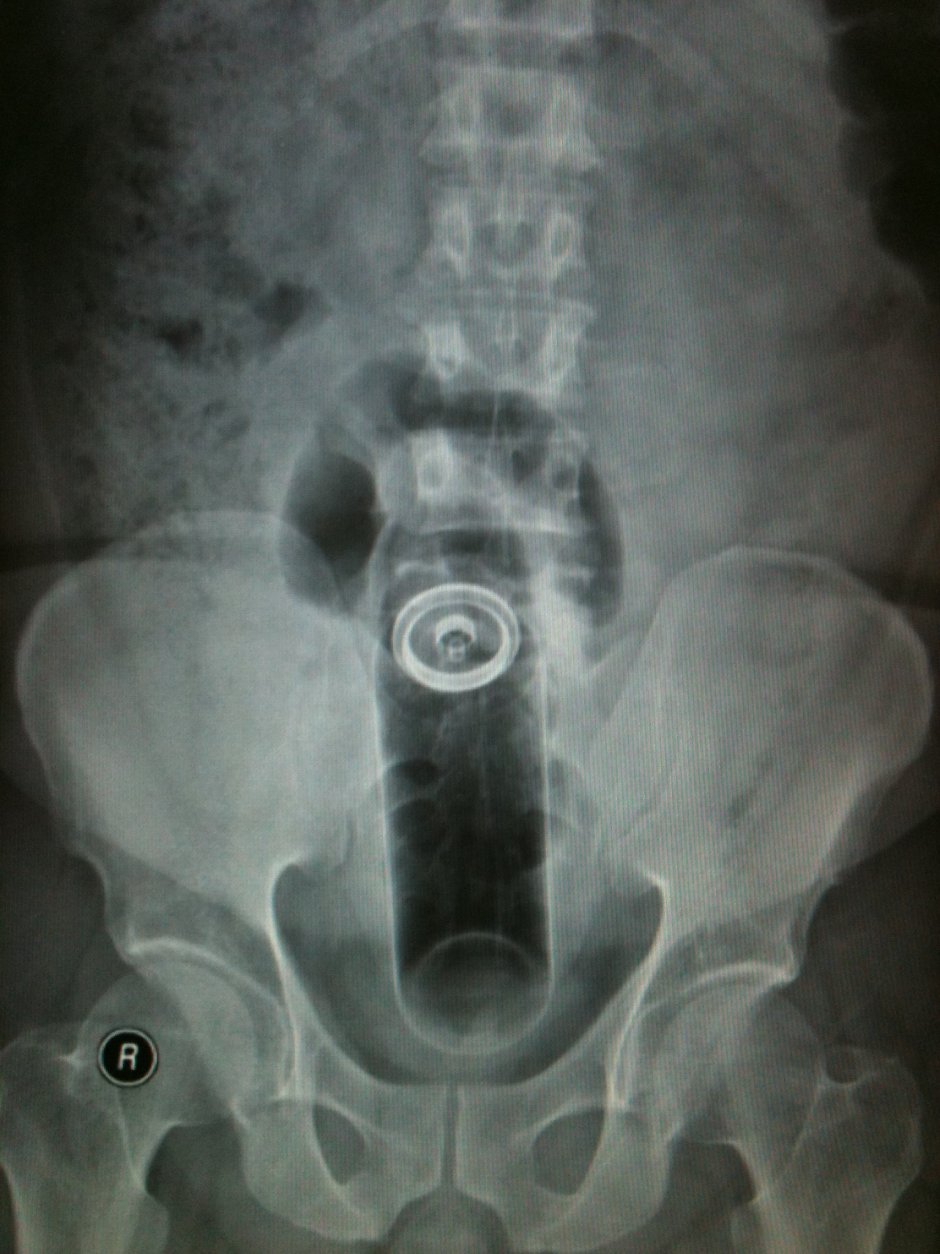 Huge objects in the vagina
