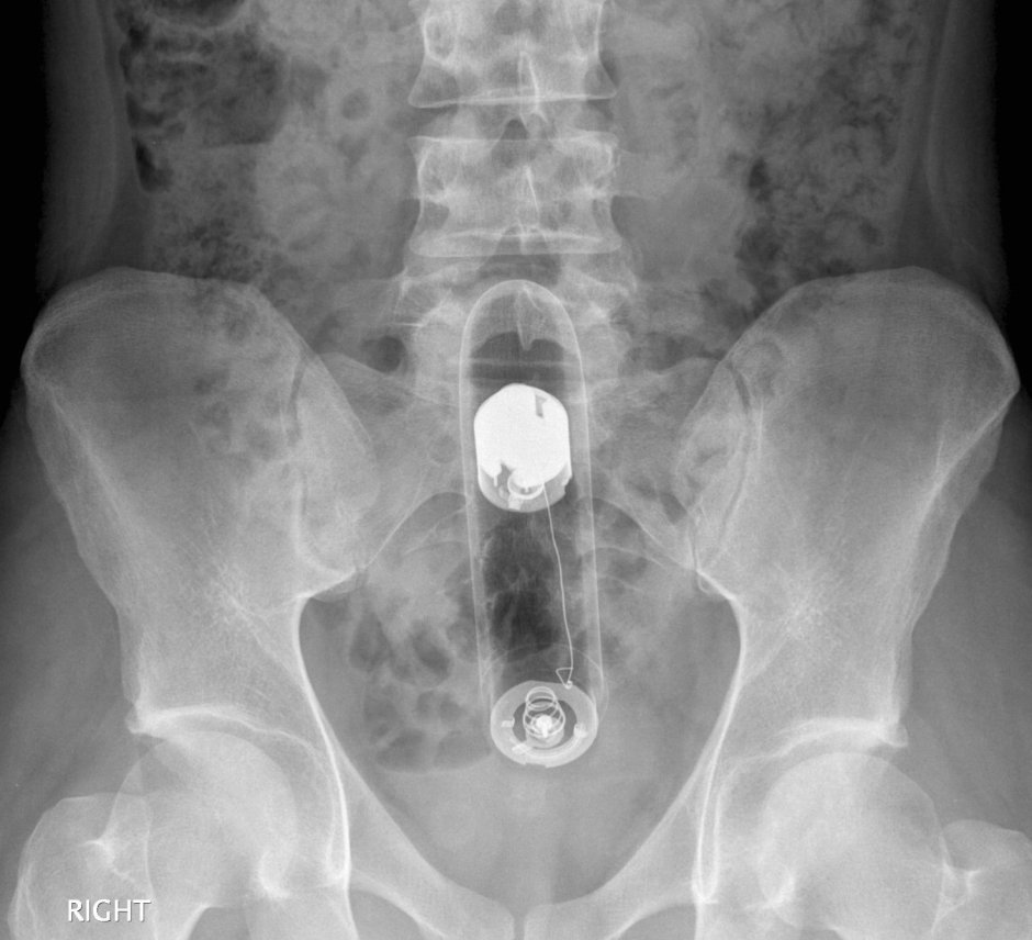 Foreign objects in the vagina