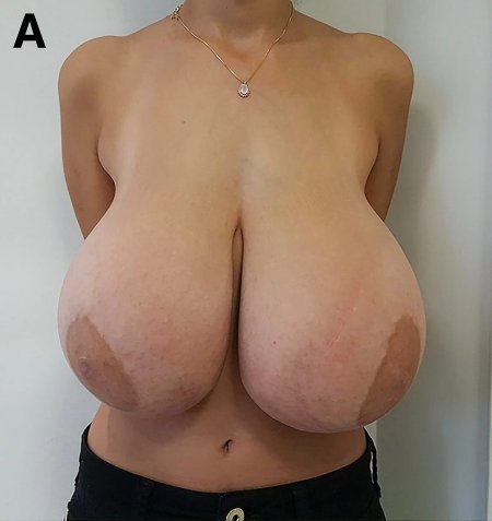 Gigantomastia without a bra