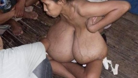 Gigantomastia Julia Manihuari