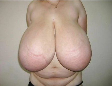 Naked tits gigantomastia