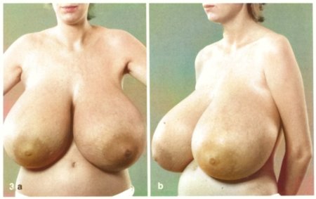 Naked women with gigantomastia