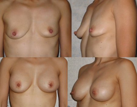 Naked boobs of the first size