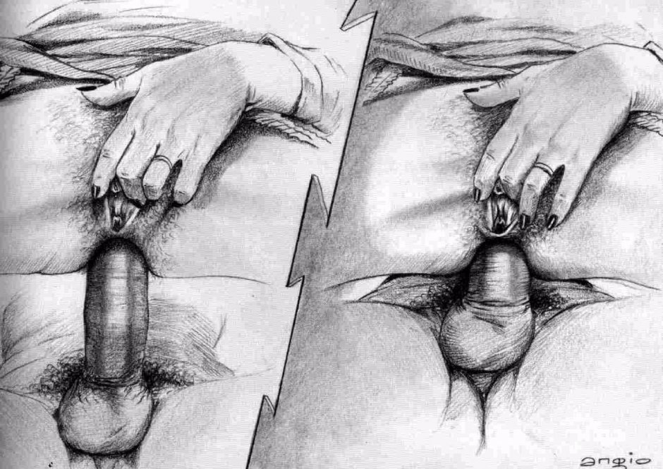 Pencil pattern of the vagina