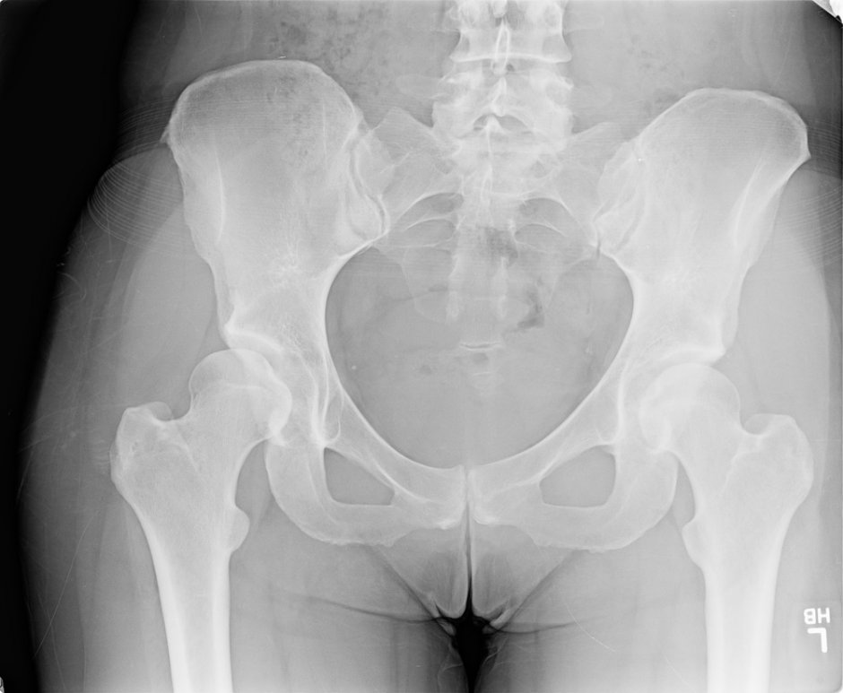 Pelvis Side View