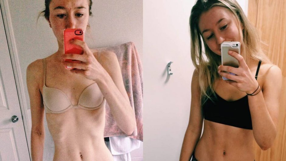 The spine of anorexics