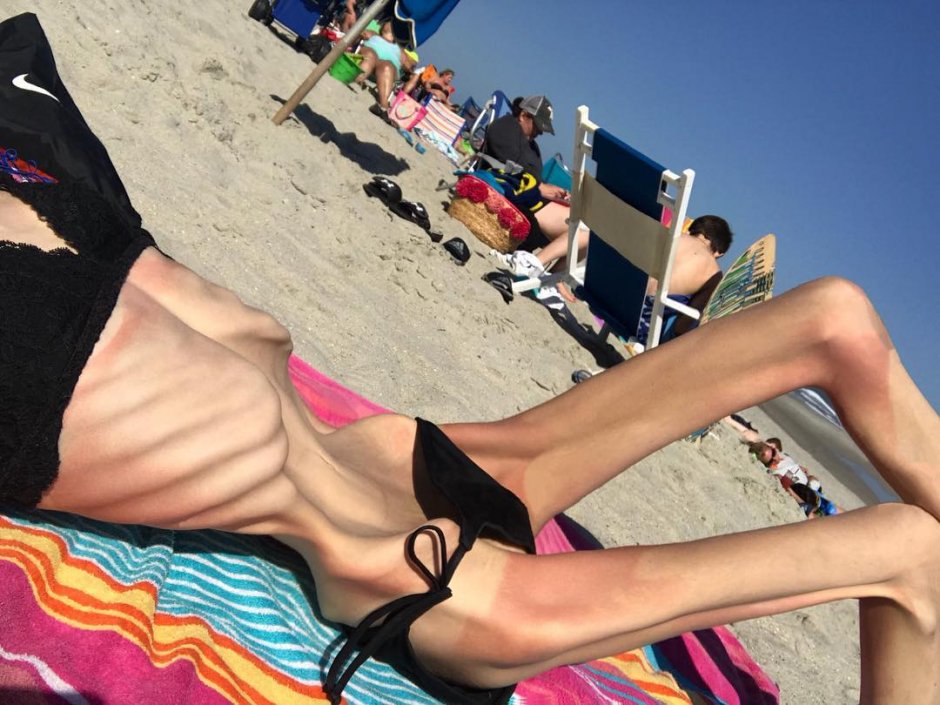 Anorexia Nina Hamilton