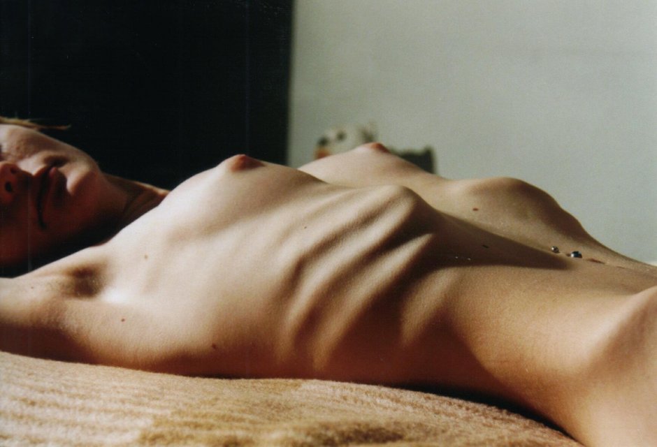 Naked women with anorexia