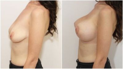 Breast Correction