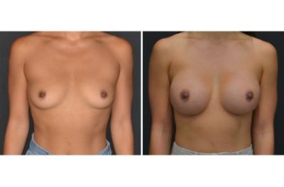 Breast Augmentation Girls