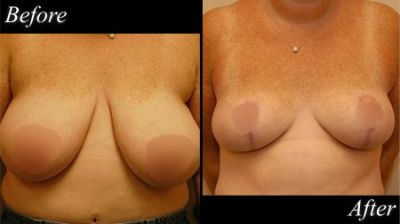 Nude Scarjo Breast Reduction