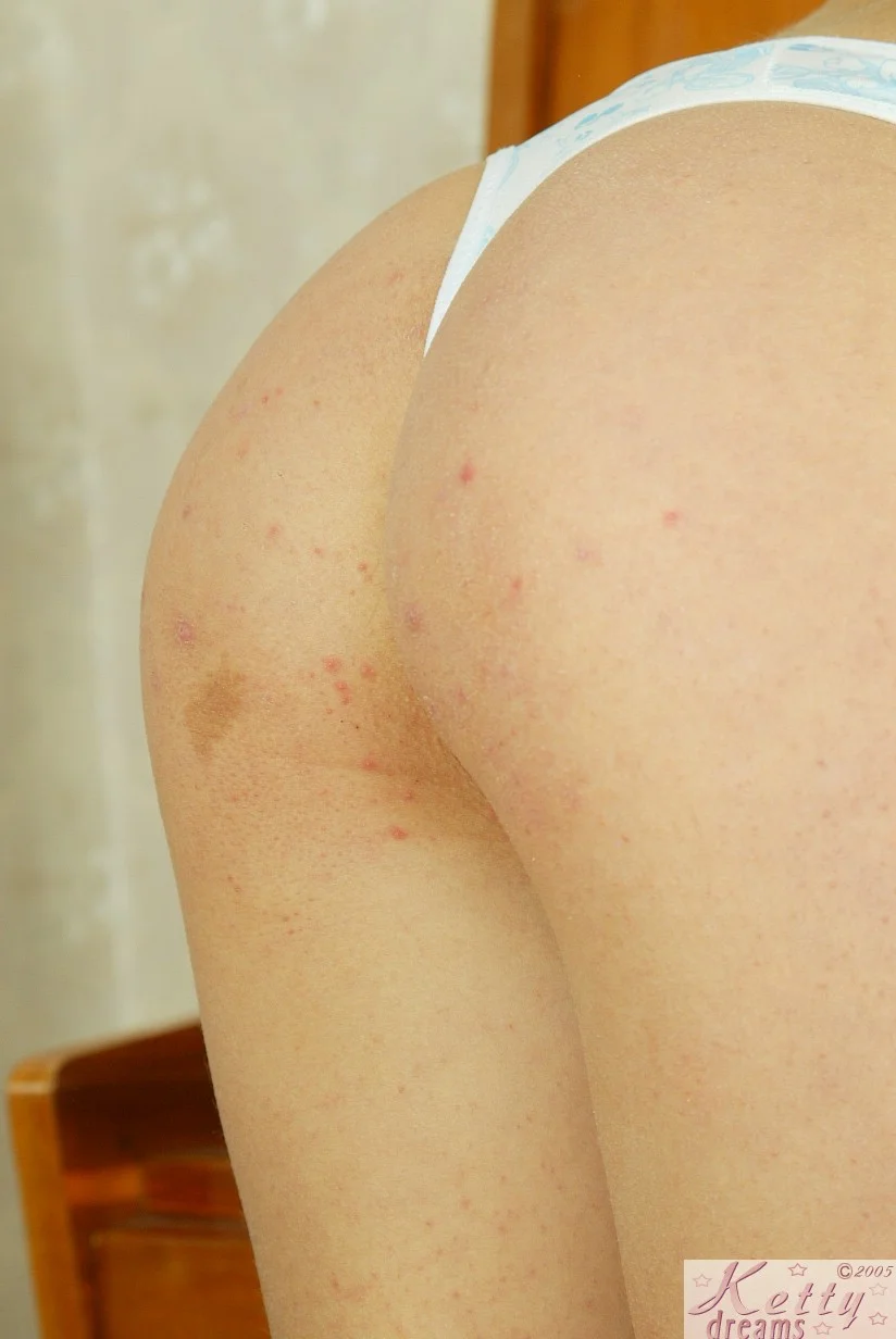 Прыщи на теле