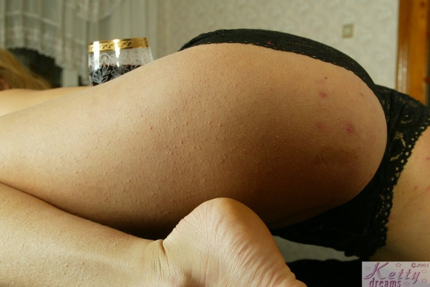 Прыщи на ягодицах