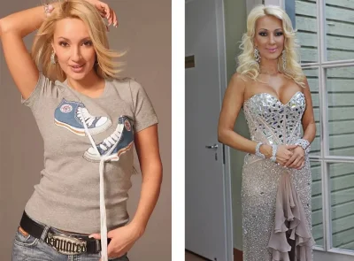 Лера кудрявцева до и после пластики