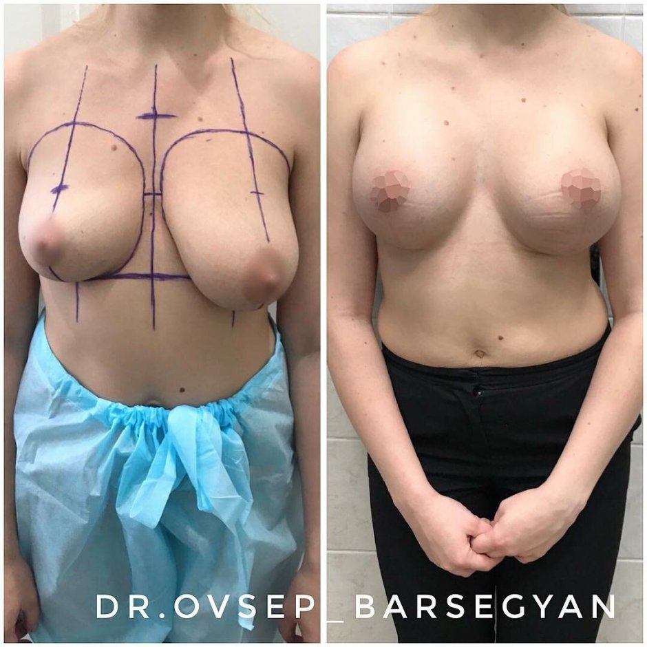 Редукционная маммопластика