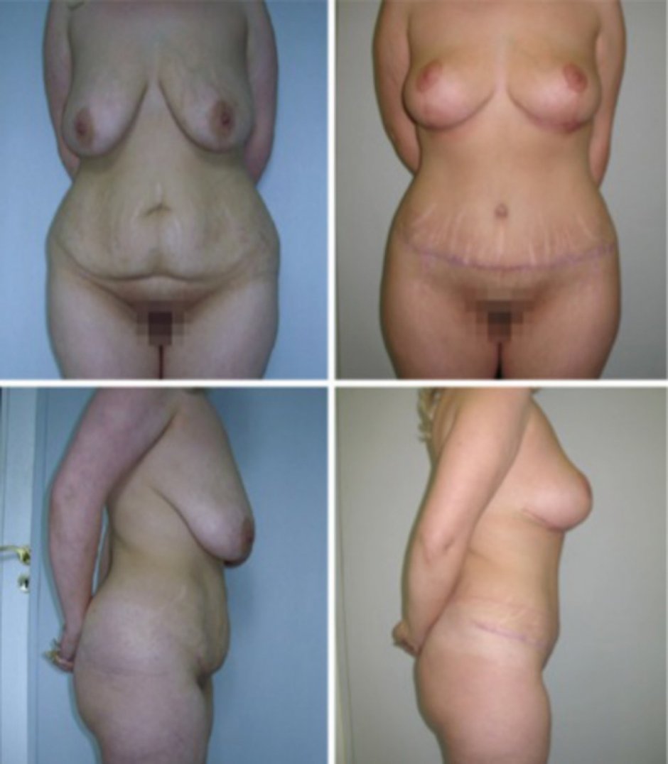 Рубец после абдоминопластики через год