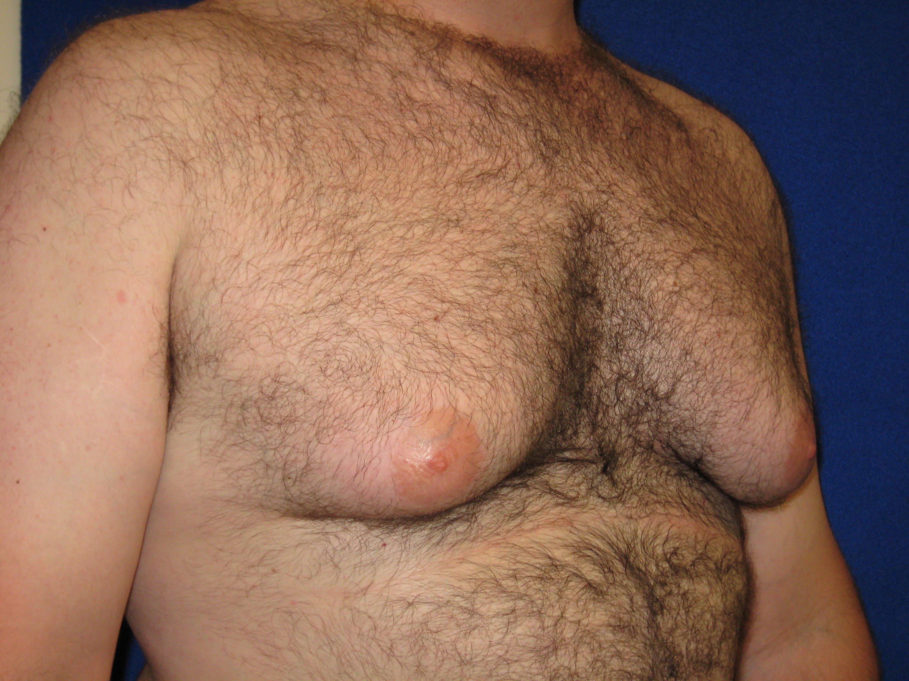 красное уплотнение на груди у мужчин фото 118