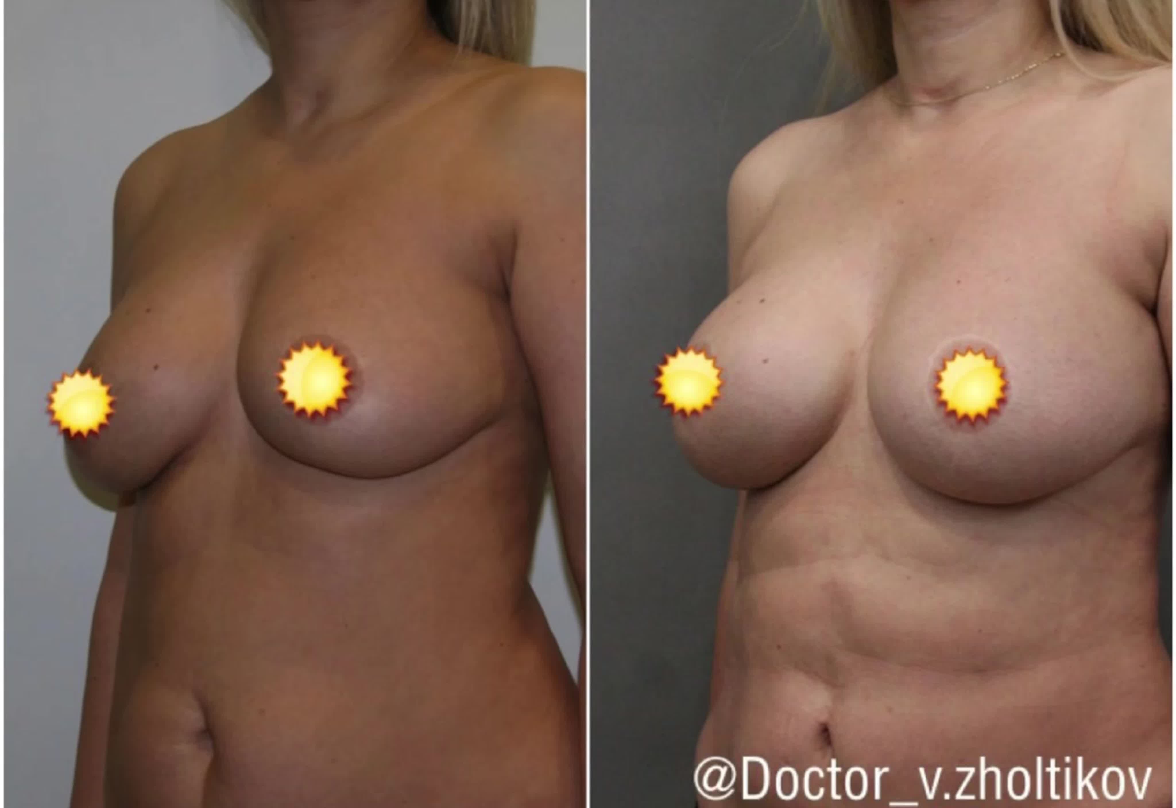 грудь с имплантами третьего размера фото 70