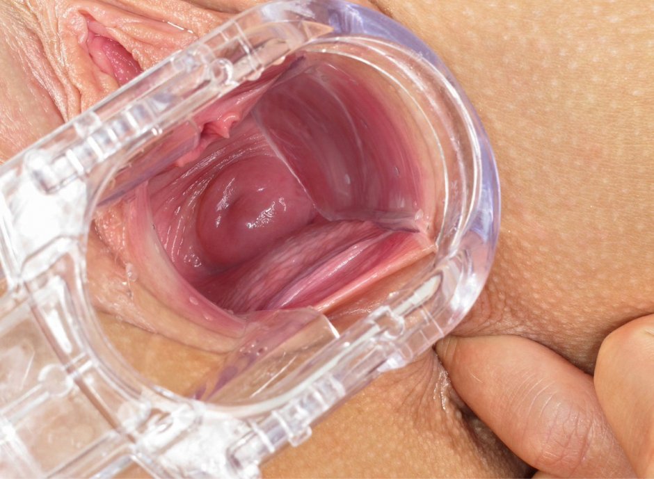 Раскрытая вагина матка