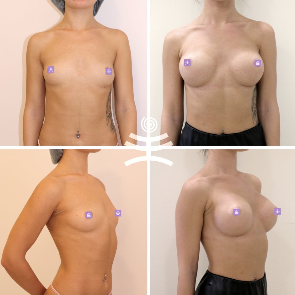 Круглые импланты