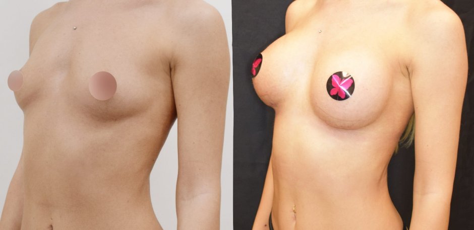 Грудь с имплантами до и после