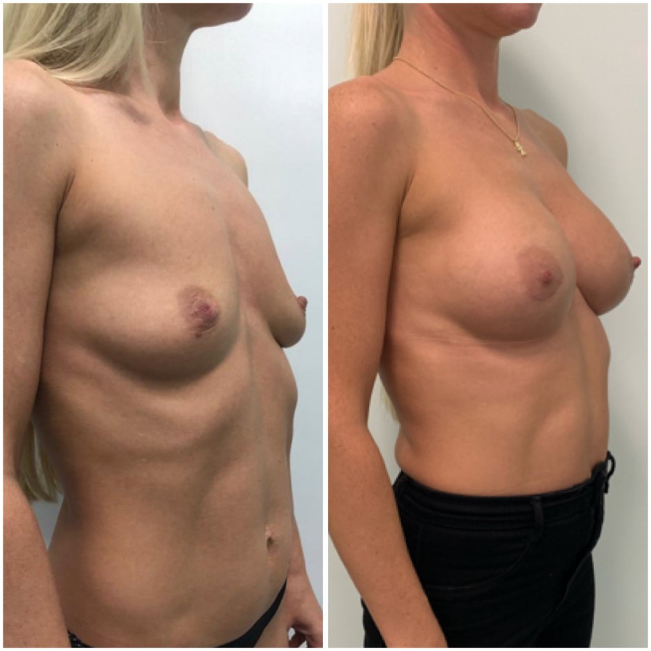 Импланты грудные через соски