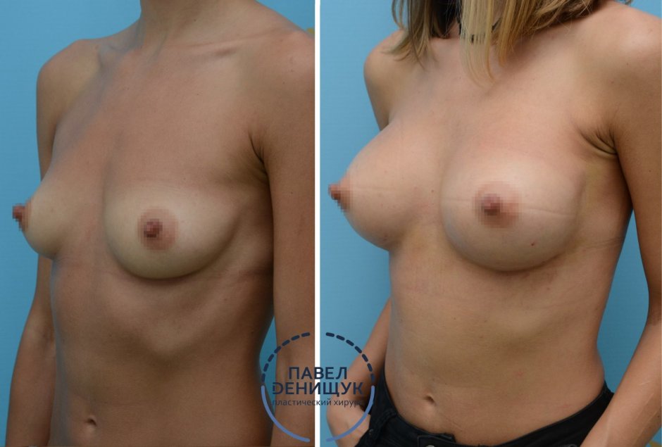 Анатомические импланты 350 мл