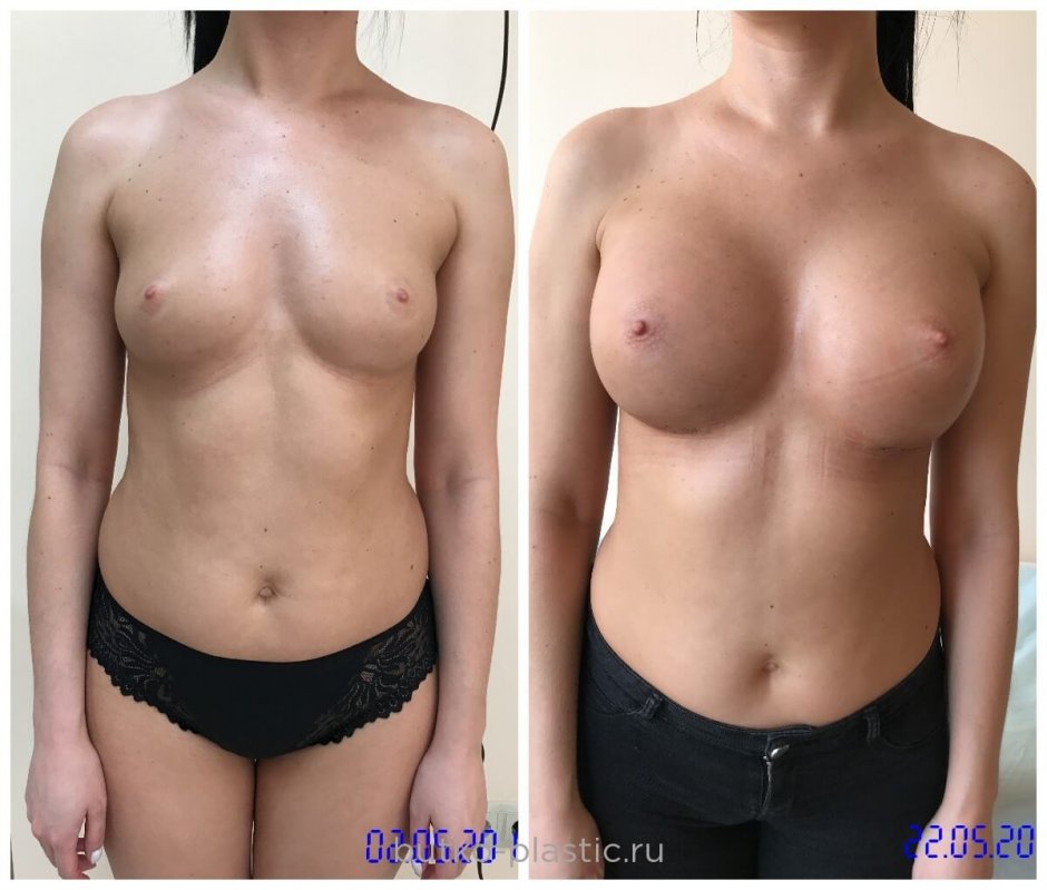 Несса девил силиконовые сиськи