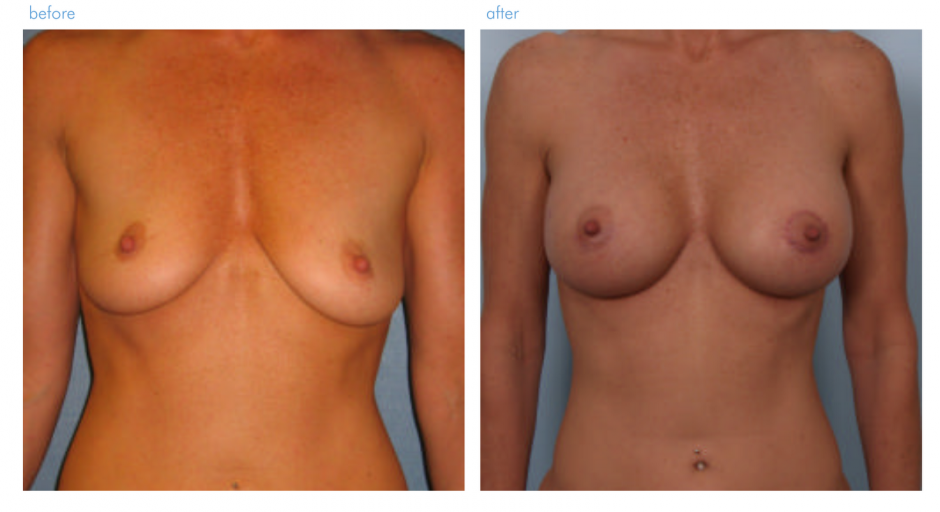 Мужские груди с женскими имплантами