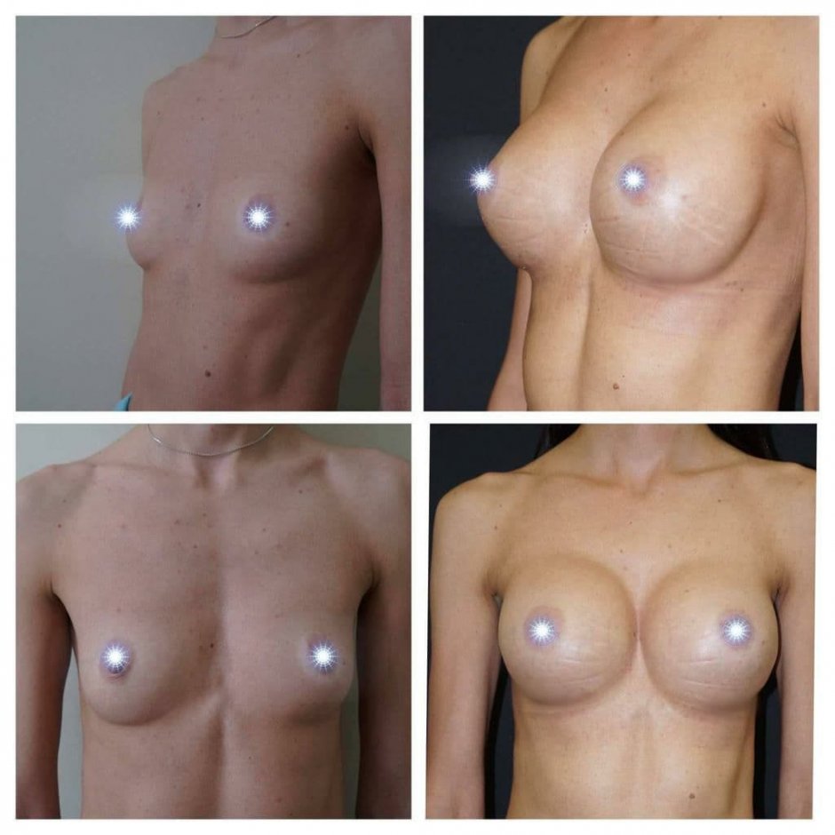 Круглые импланты сиськи