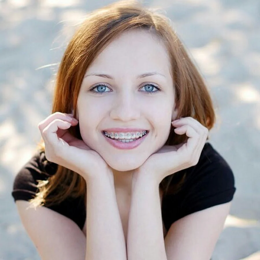 Современные брекеты для подростков