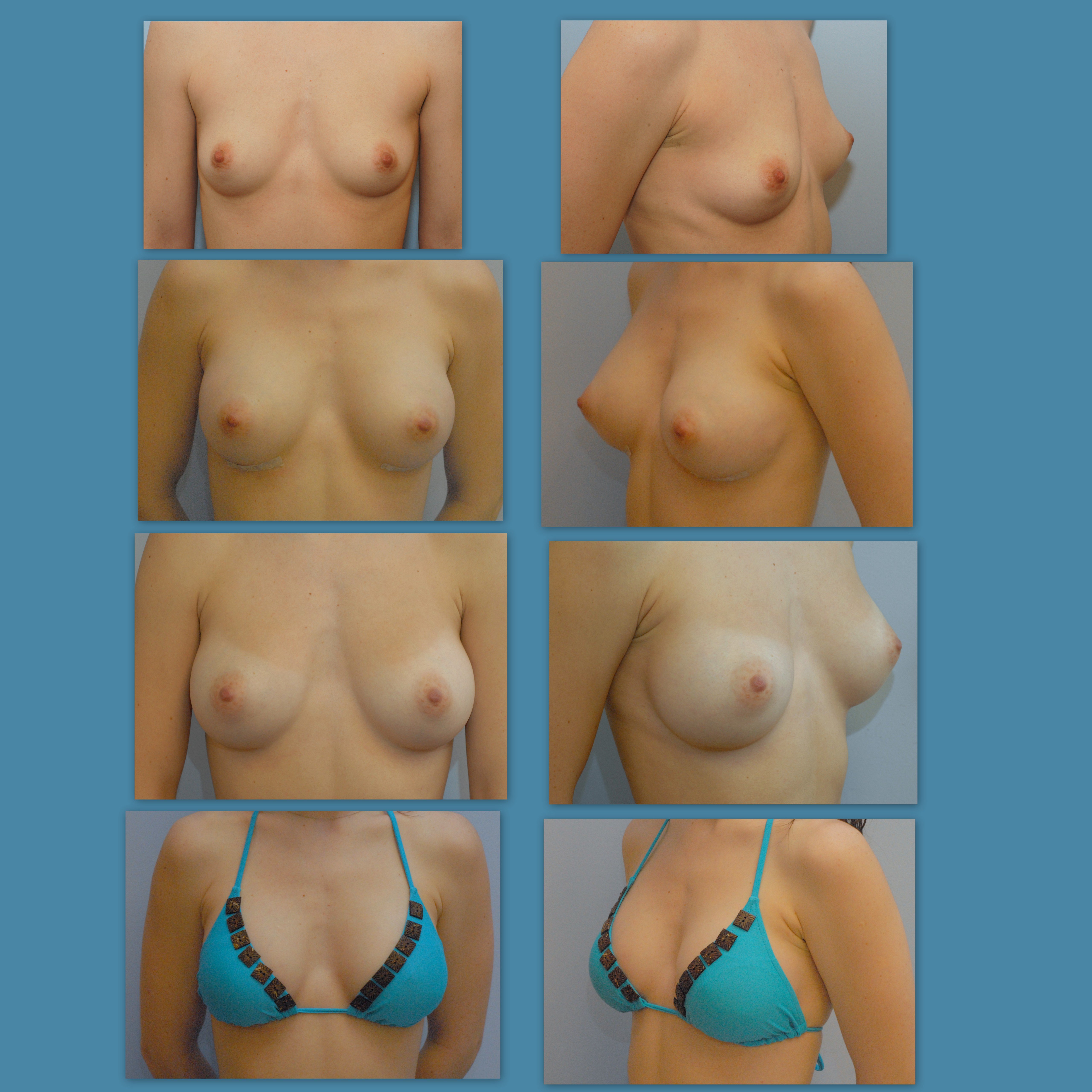 примеры груди разных размеров фото 82