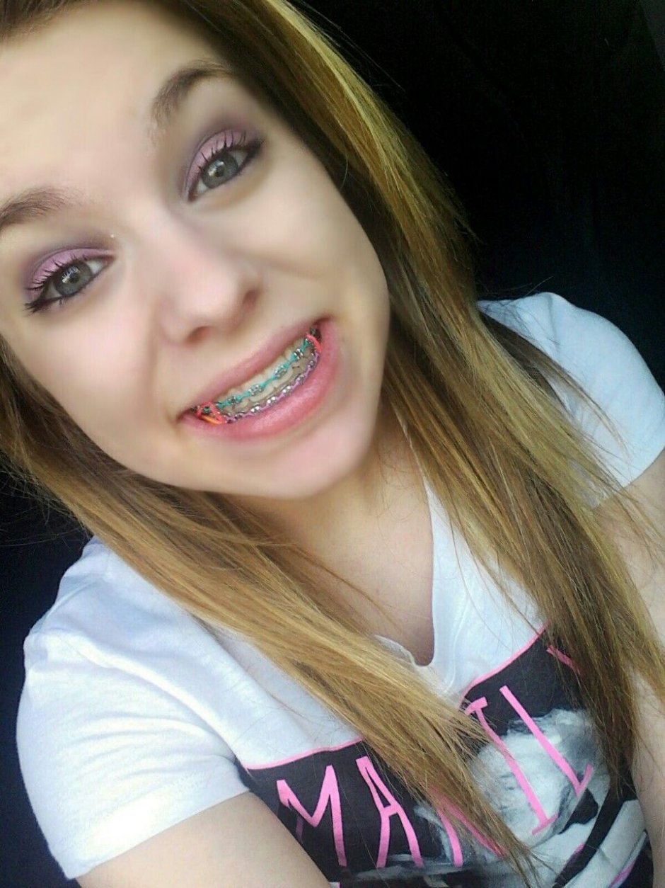 Брекеты и очки