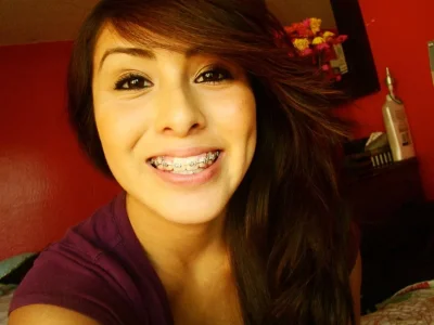 Брекеты у женщины с большими губами