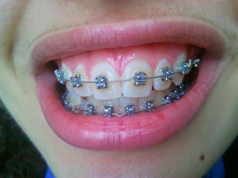 Блондинка с брекетами