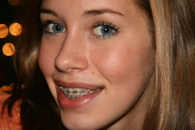 Керамические брекеты улыбка