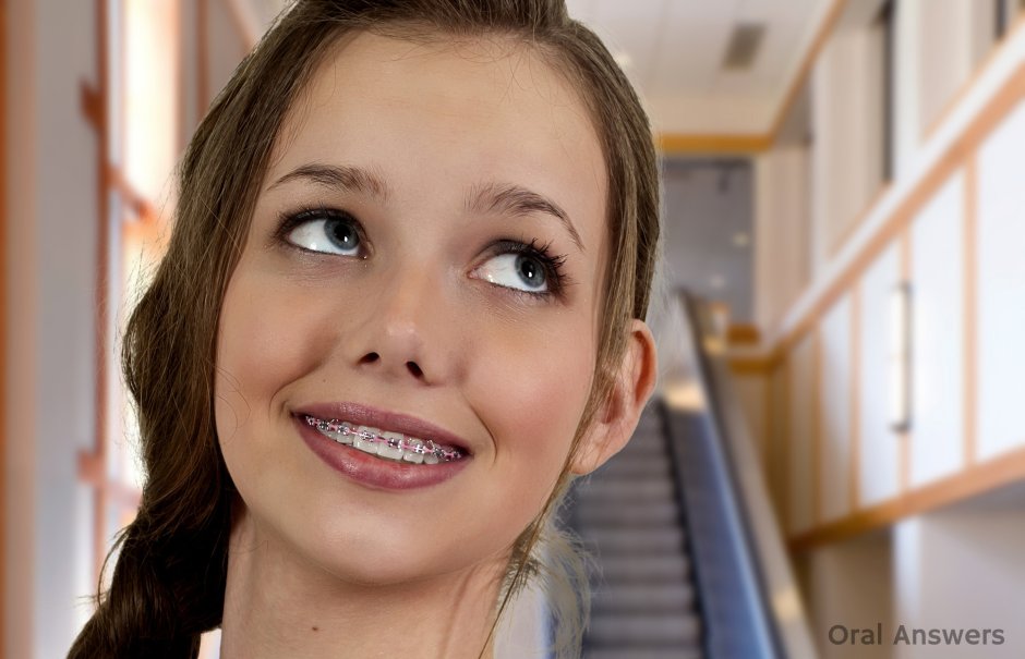Брекеты улыбка
