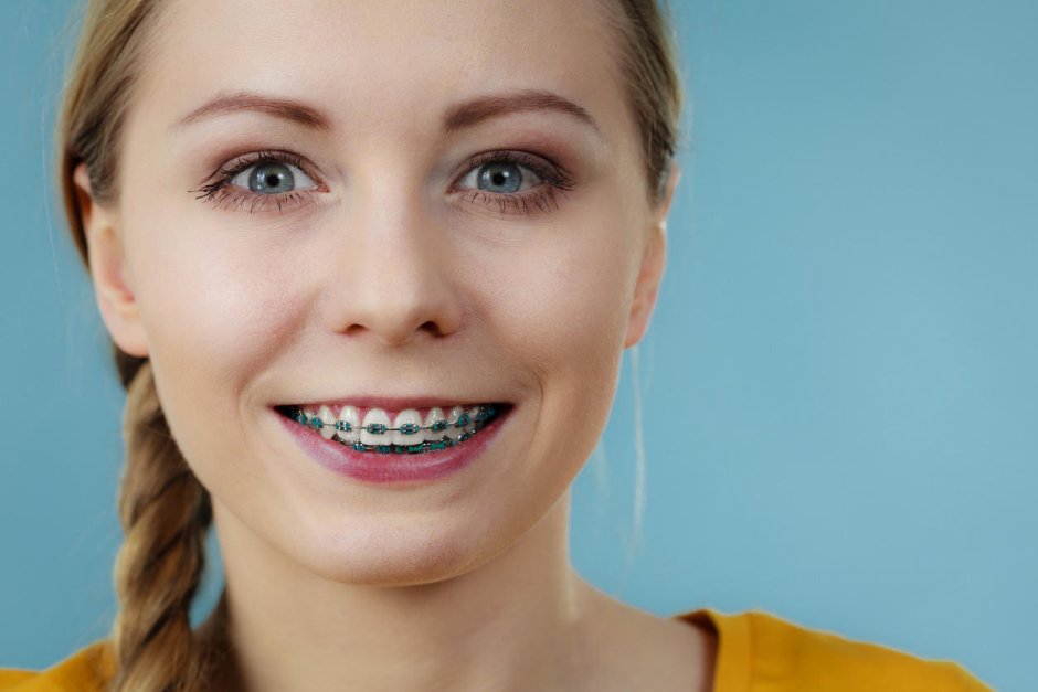 Девушка в прозрачных брекетах