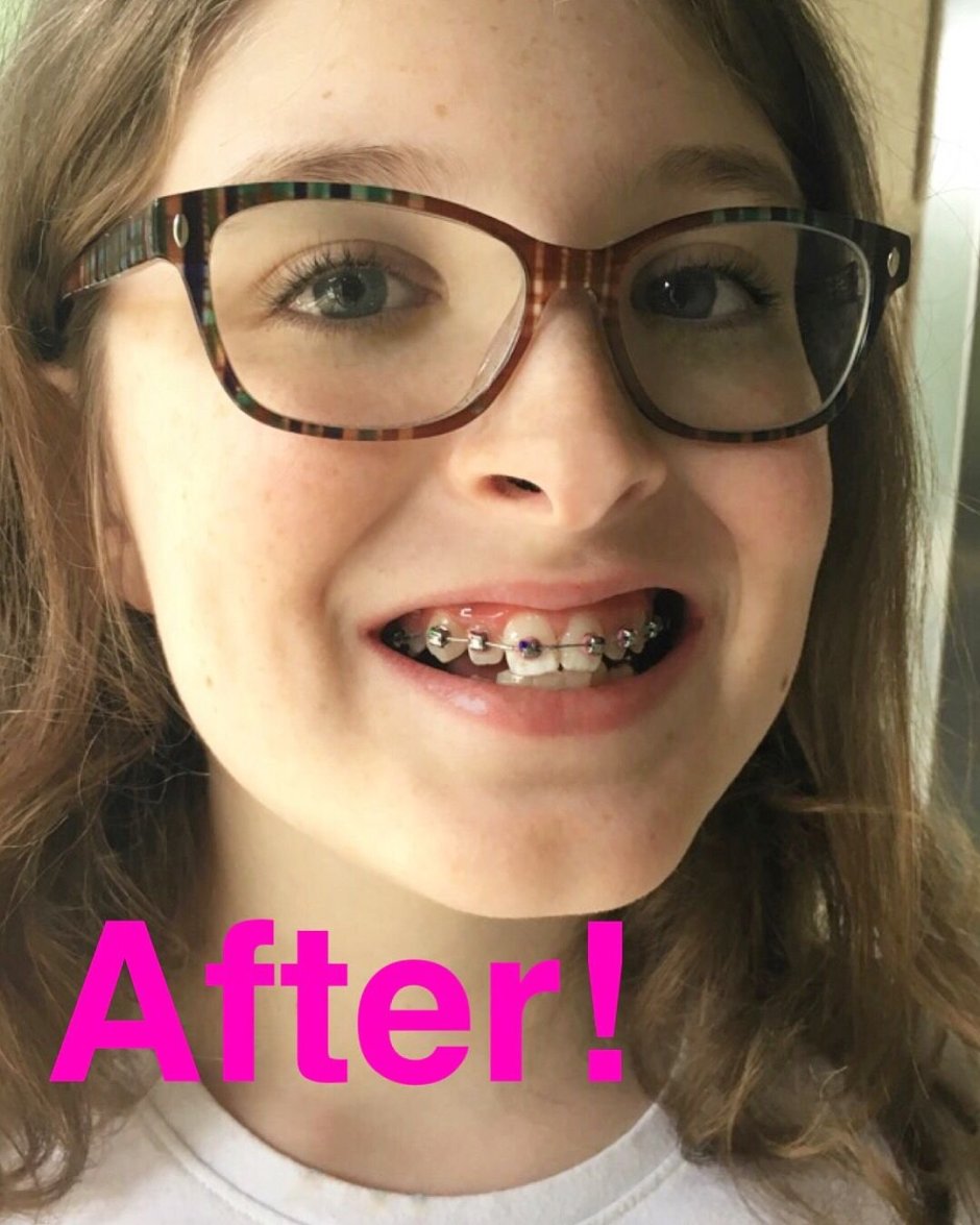 Красивые брекеты для девочек с камнями