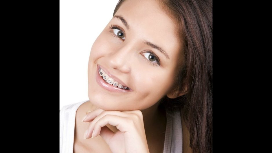 Смешные люди в брекетах