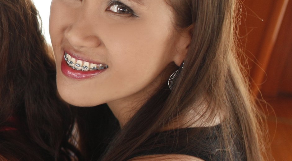 Люди с брекетами