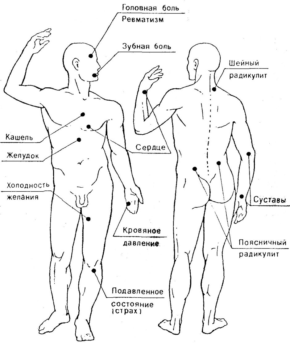 Схема триггерных точек на теле