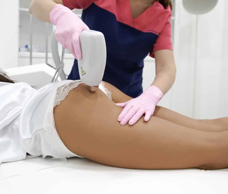 Лазерная эпиляция ягодиц