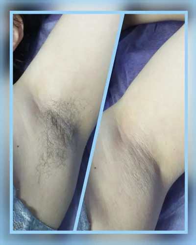 Шугаринг бикини глубокое